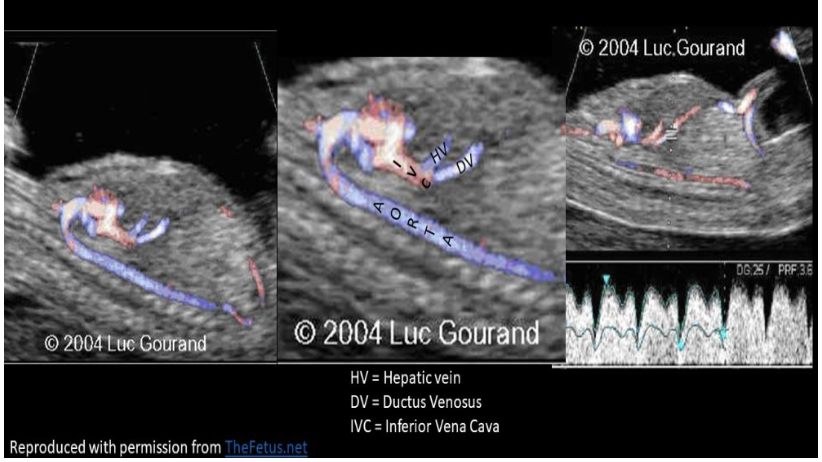 <p>which describes the vessels that allows some <strong>umbilical bloo</strong>d to bypass the <strong>fetal</strong> liver in fetal circulation</p><p>a) foramen ovale</p><p>b) ductus venosus</p><p>c) ductus arteriosus</p><p>d) umbilical vein</p>