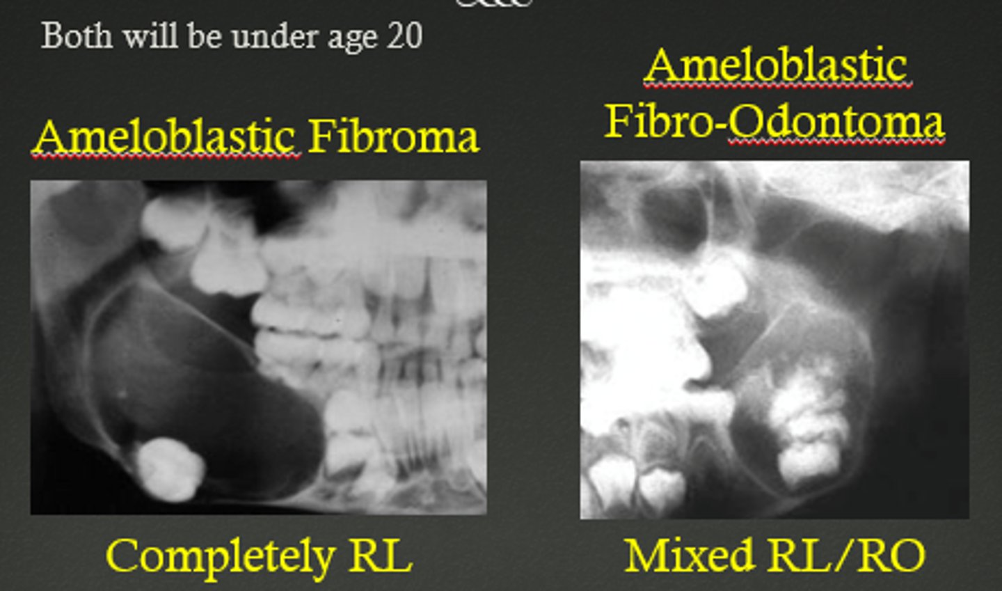 <p>Ameloblastic fibroma</p>