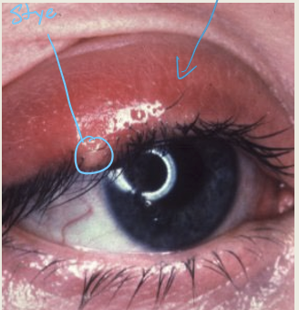 <p>An acute staphylococcal infection of the eyelash and gland of Zeis </p>