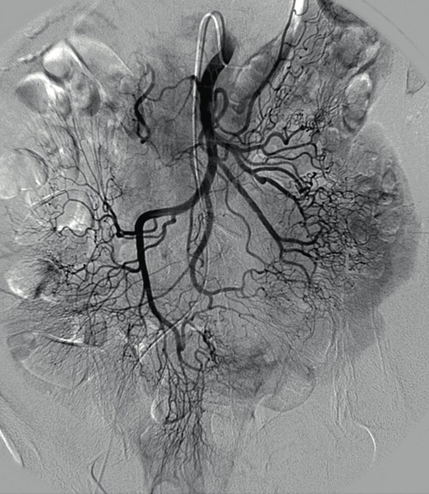 <p>48. This image shows an angiogram, which is an X-ray image taken after a contrast agent has been injected through a catheter into an artery. The visible branching pattern indicates which organs or regions the injected artery supplies.</p><p>Which of the following arteries belongs to the vascular territory of the contrast-filled artery shown in this image?</p><p>A. Appendicular artery (A. appendicularis)</p><p>B. Left colic artery (A. colica sinistra)</p><p>C. Dorsal pancreatic artery (A. pancreatica dorsalis)</p><p>D. Superior rectal artery (A. rectalis superior)</p><p>E. Left renal artery (A. renalis sinistra)</p>