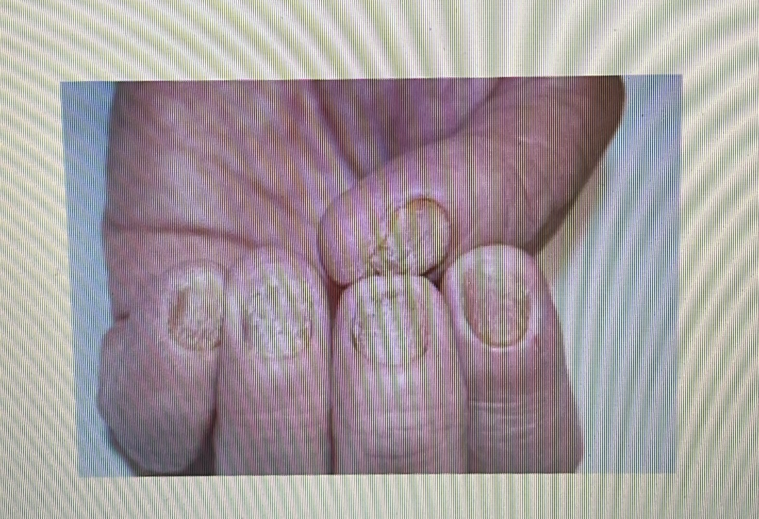 <p>NAIL DISORDER</p><p><span style="font-family: Calibri, sans-serif"><strong>Psoriasis of the nails</strong>: A skin condition that causes pitting, nail discoloration and other symptoms.<br></span></p>