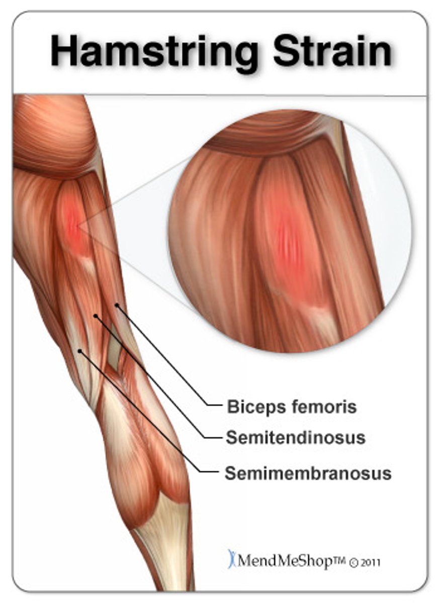 <p>Painful overstretching of a tendon or muscle without serious tissue damage, often due to inadequate warm-up before exercise.</p>