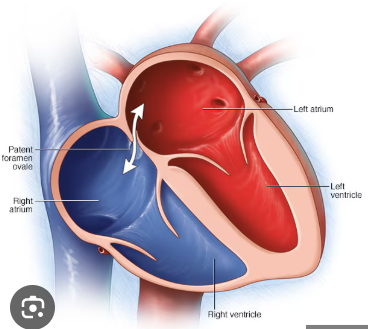<p>small opening in the septum (wall), between the upper chambers of the heart (atria) that is present in all fetuses during pregnancy</p>