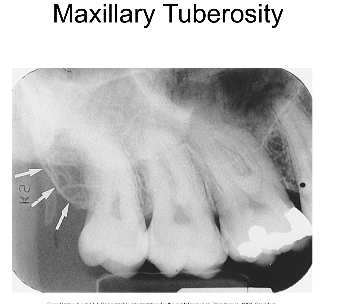 radiopaque bulge distal to the third molar region