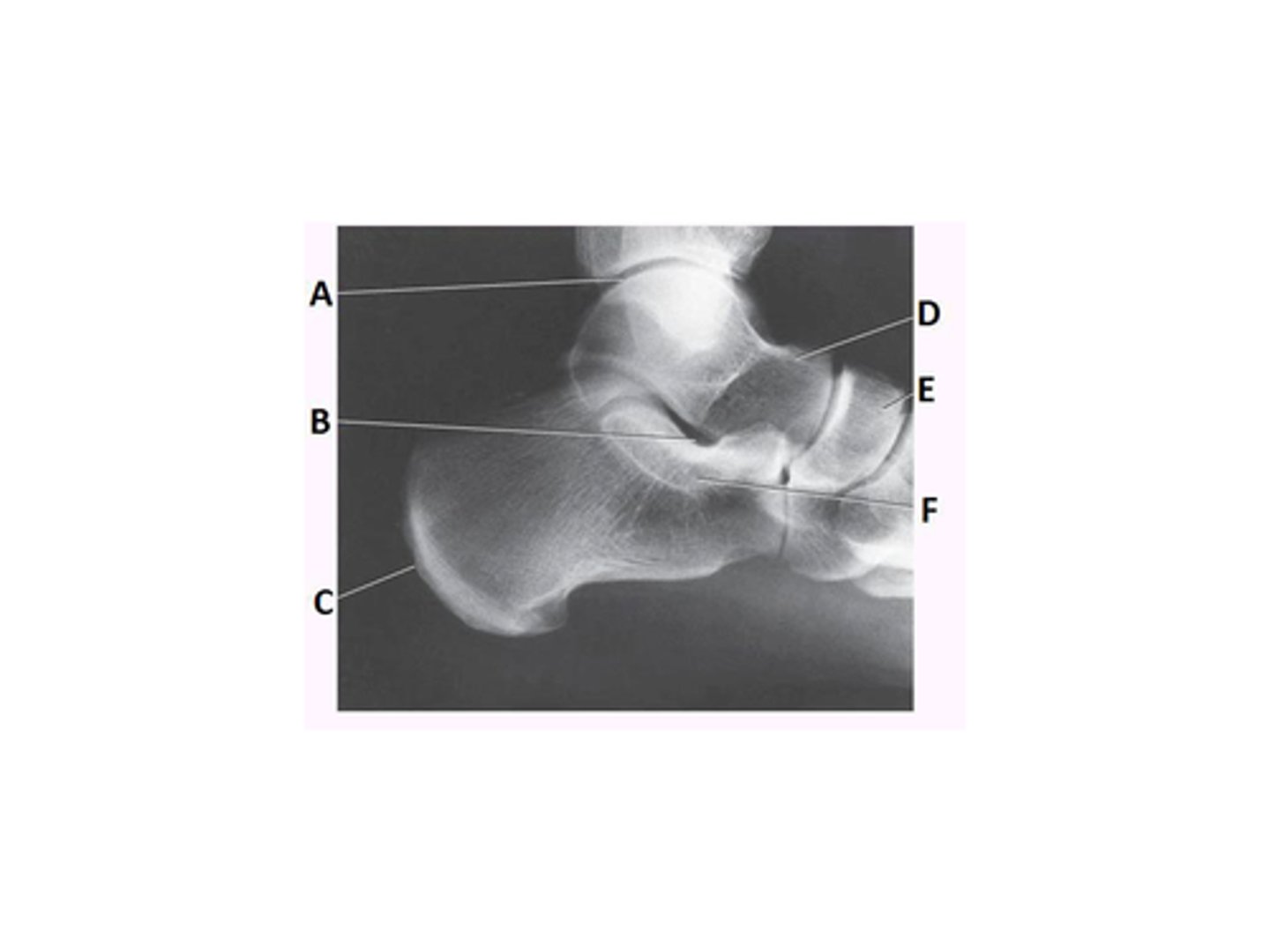 <p>What anatomy is labeled as letter E in the image below?</p><p>Sinus tarsi</p><p>Sustentaculum tali</p><p>Navicular</p><p>Tibiotalar joint</p>