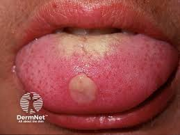 <p>PP: ulcerated papule+indurated edge<br>-contagious</p><p>E: 3-6 weeks post t pallidium infxn</p>
