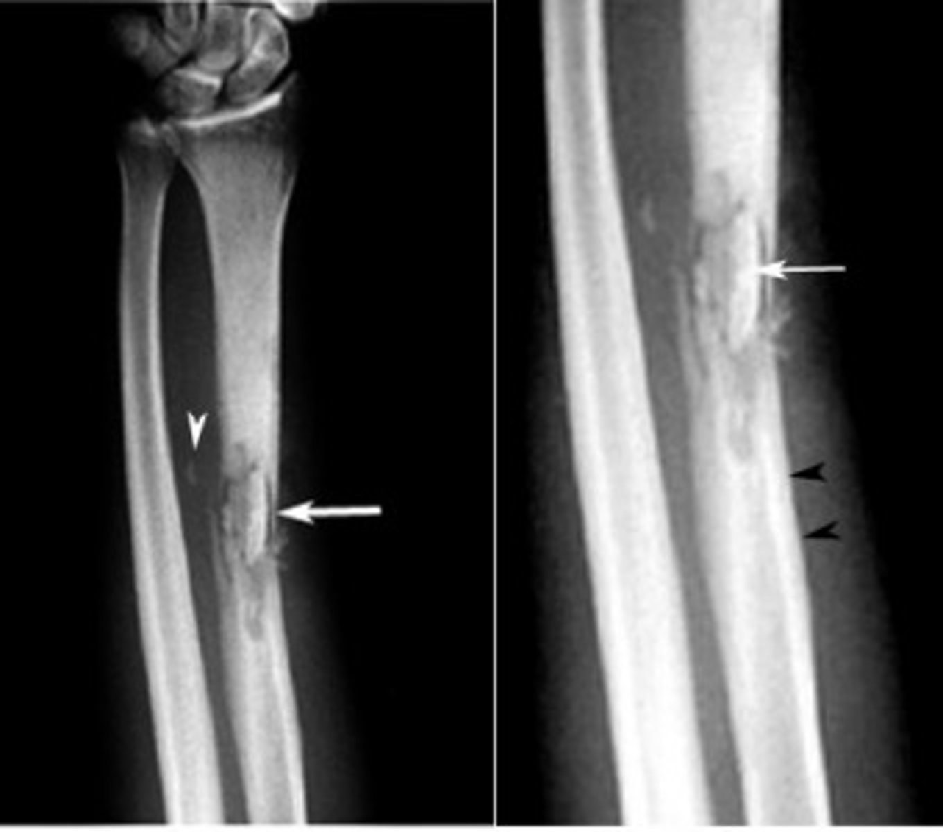 <p>Area of dead bone separates from living bone.</p><p>⢠Antibiotics have difficult time reaching sequestrum</p><p>⢠Sequestrum needs surgical debridement or sinus tract develops and purulent drainage leaks out</p>