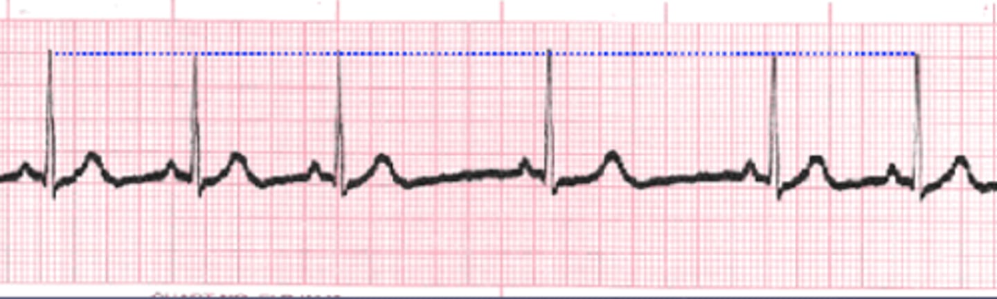 <p>Normal beats but they are triggered at irregular intervals.</p>