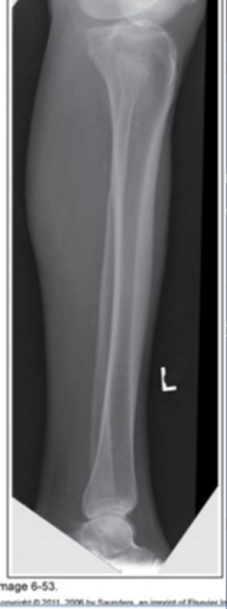 <p>Patella rolled away from IR (posterior rotation)</p>