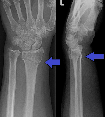 <p>What angulation can be seen here? </p>