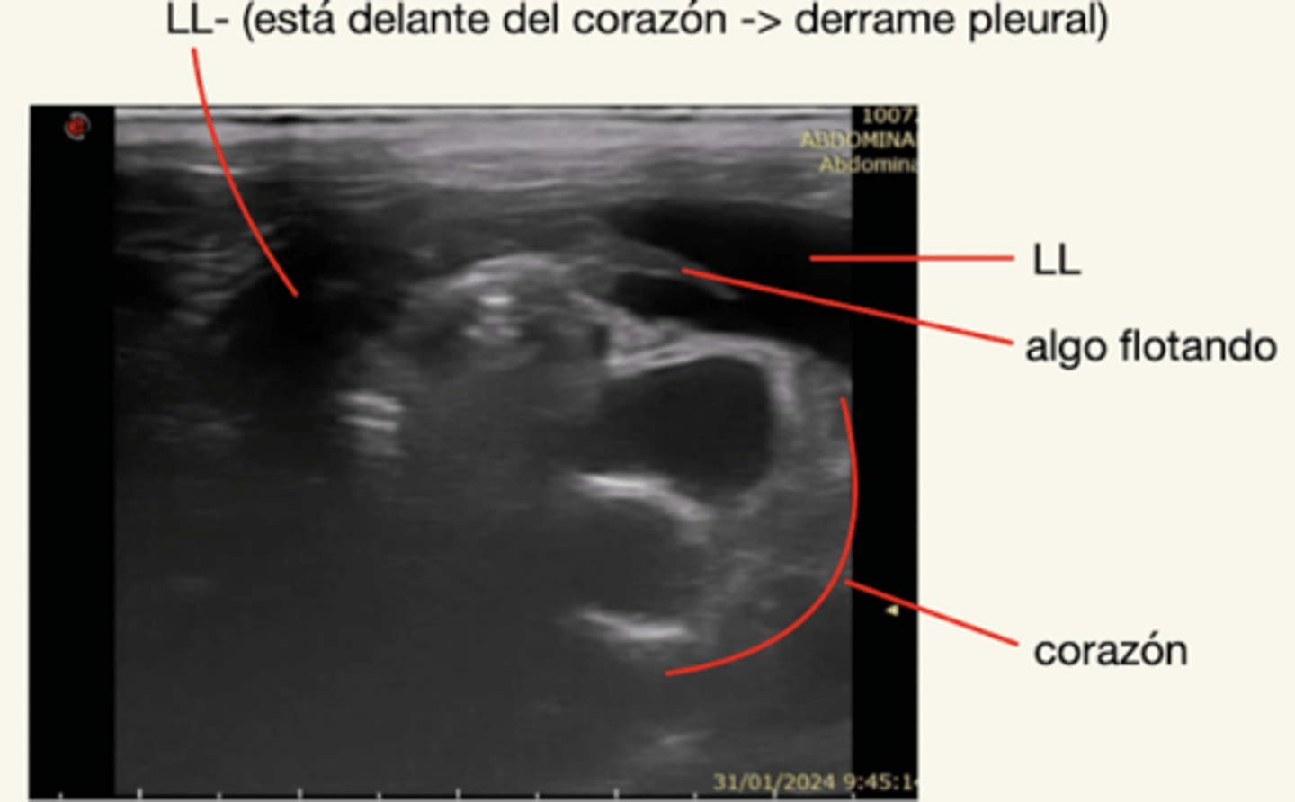 <p>líquido libre (anecóico) delante del corazón</p>