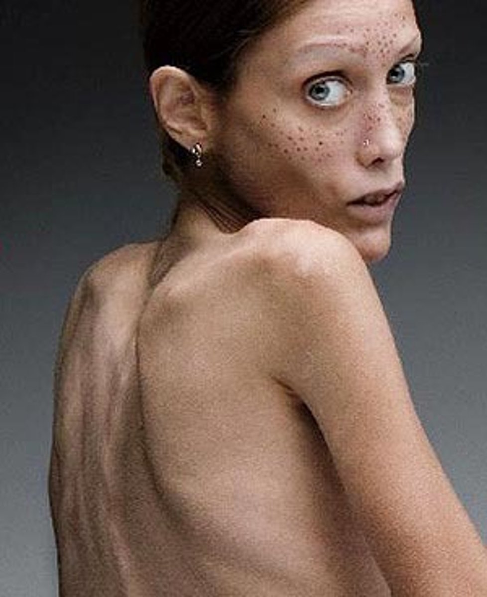 <p>la anorexia</p>