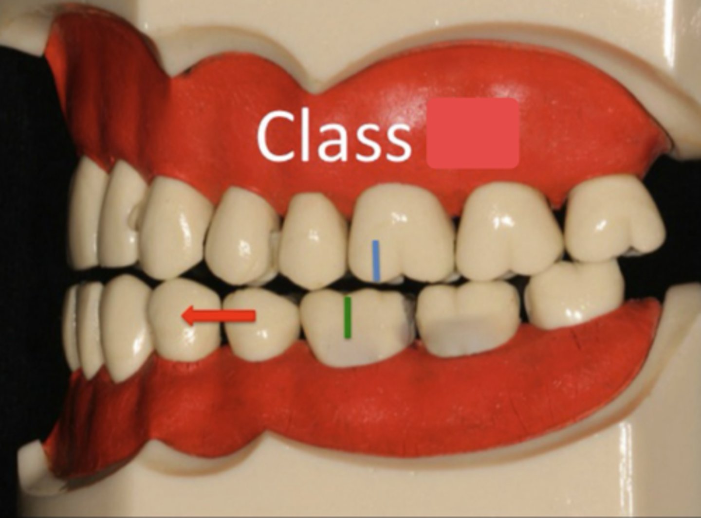 <p>ID the occlusion classification:</p>