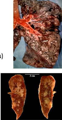 <ul><li><p>occurs in tuberculosis (infection with Mycobacterium tuberculosis)</p></li><li><p>due to type 4 hypersensitivity reaction and nature of bacterium</p></li><li><p>caseous necrosis of lung</p></li><li><p>appears like cottage cheese, very crumbly</p></li></ul><p></p>