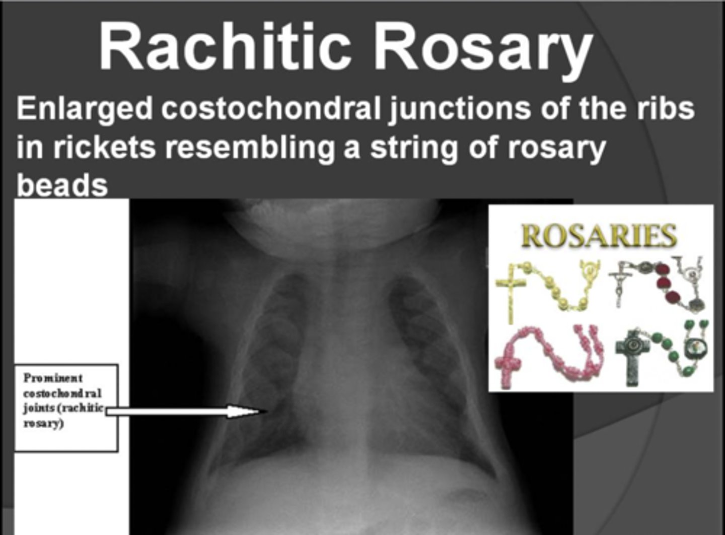 <p>- craniotabes (soft skull)</p><p>- frontal bossing</p><p>- <strong>"rachitic rosary"</strong> (chest deformity)</p><p>- bowed legs, lumbar lordosis</p>