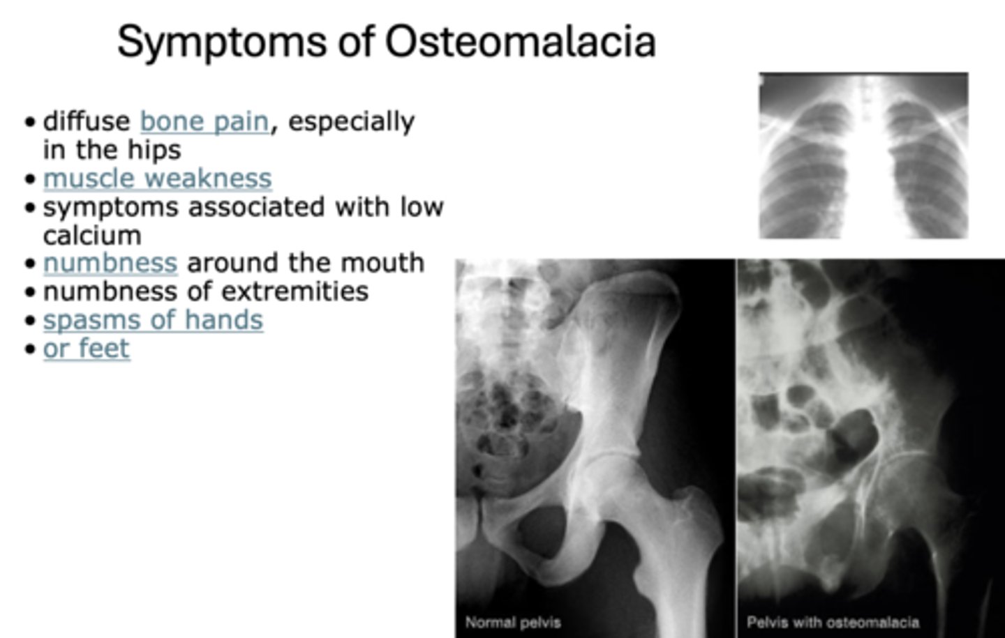 <p>Osteomalacia</p>