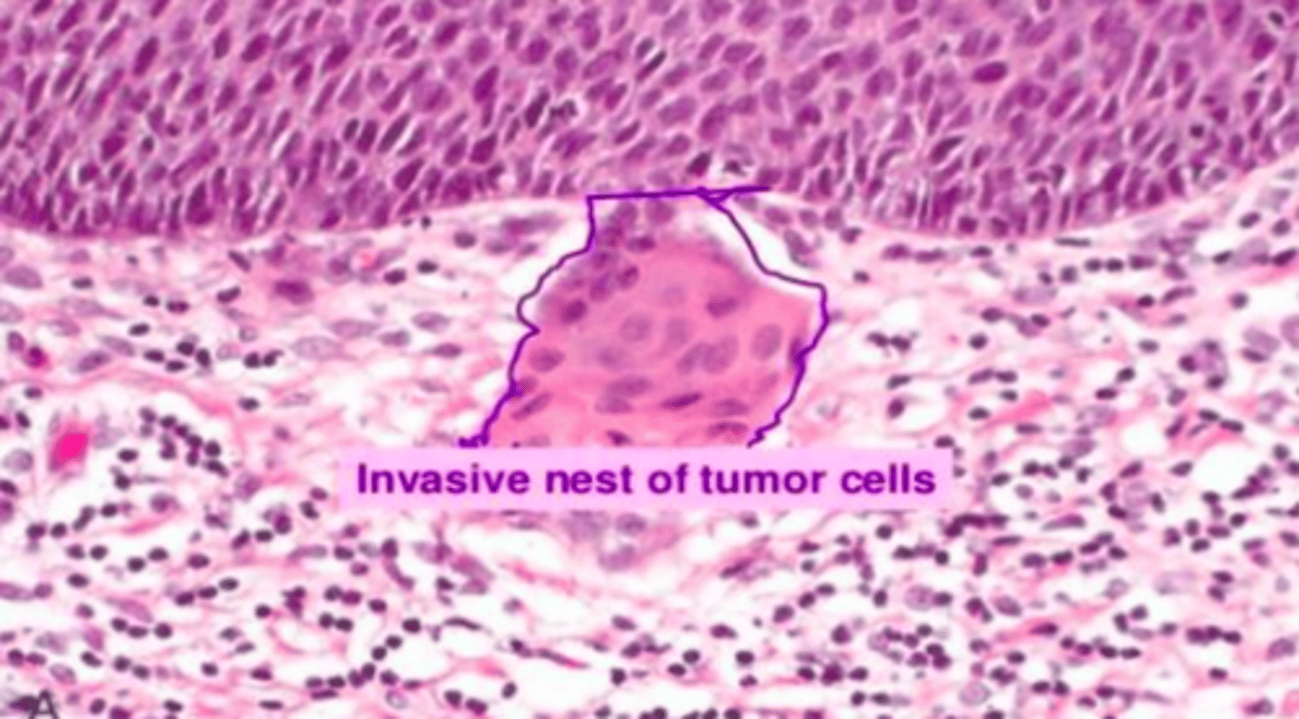 <p>Malignant tumor of the squamous epithelial cells in the epidermis</p>