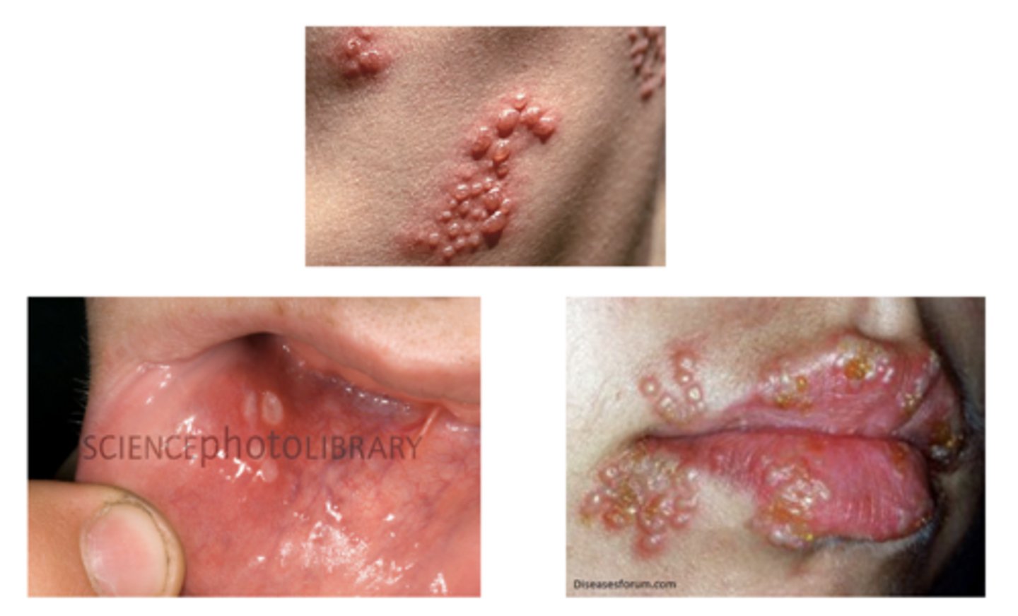 <p>When do HSV blister usually resolve?</p>
