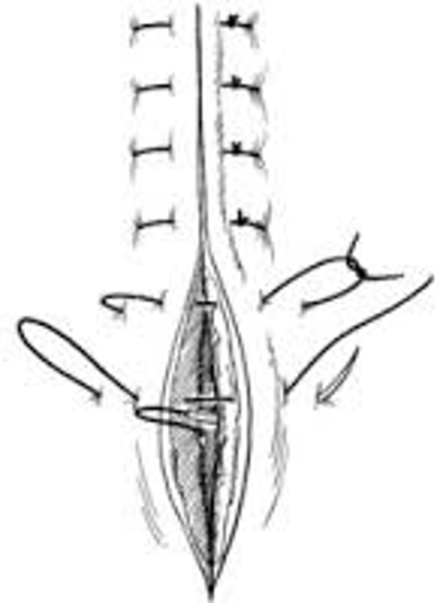 <p>in creases and areas of natural inversion (back of hand, or other sites of loose skin)</p>