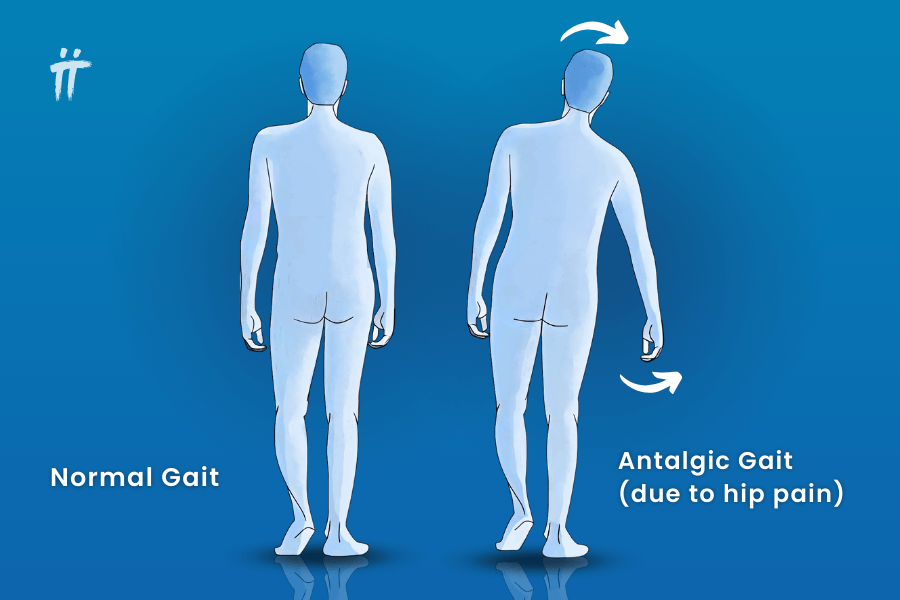 <p><strong>Impairment:</strong> <span style="color: blue">Pain in the stance limb</span><br><strong>Deviation/Compensation:</strong> <span style="color: red">Antalgic gait</span> — reduced stance time on painful leg, shortened opposite step length</p><ul><li><p>ant = against</p></li><li><p>-algic = pain</p></li></ul><p><strong>Ex:</strong> Jandro quickly shifts weight off the painful <strong>R leg</strong>, so the <strong>L leg swings earlier</strong>, making the <strong>L step shorter</strong></p>