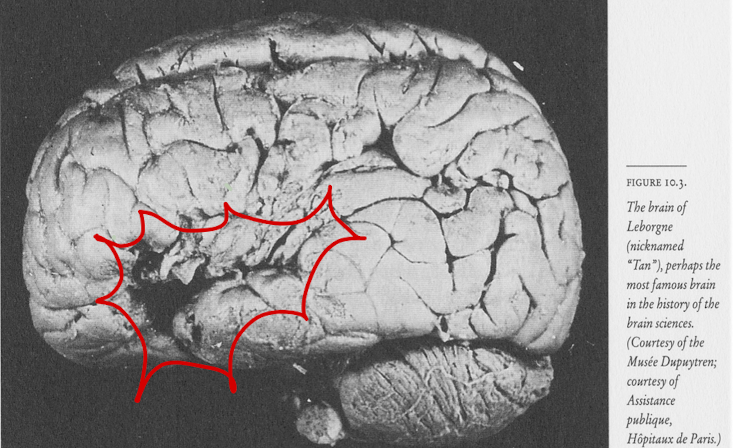 <p>inability to use or understand language (deficit in speech) because of a brain lesion</p><p>person: paul broca</p>