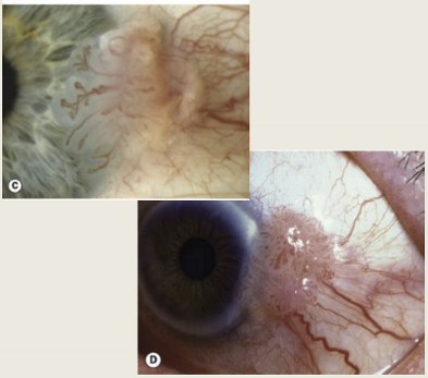<p>OSSN is a slowly progressive lesion of the conjunctiva/cornea that may be benign, premalignant, or malignant. It typically affects males more in US and Europe and women in Africa </p>