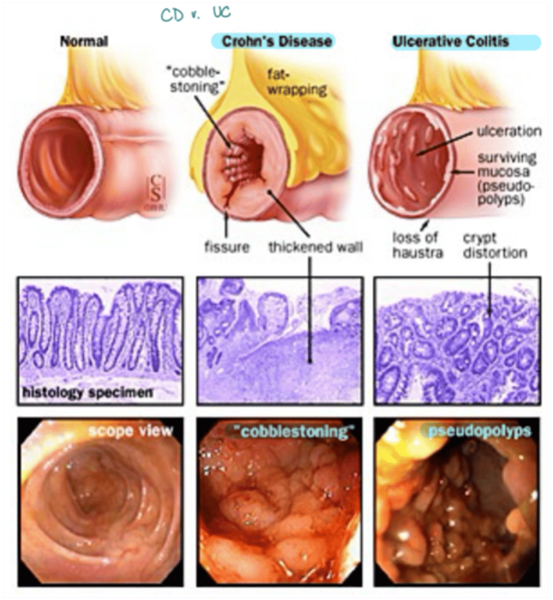 <p>· CD usually presents as "cobblestoning"</p><p>· UC usually presents as pseudopolyps that are more segregated</p>