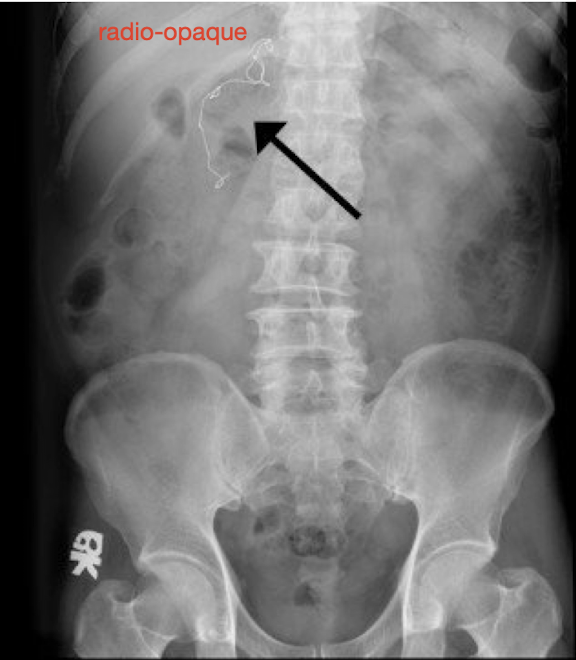 <p><strong>Counting all sponges and instruments in sequence during closure to prevent retained surgical instruments before and after operative procedure</strong><br><span style="color: red">-<strong><em>NEVER cut/alter a sponge or towel (</em></strong><em>radio-opaque detectable by XRAY)</em></span><br>-should be documented before and after and shift change</p>