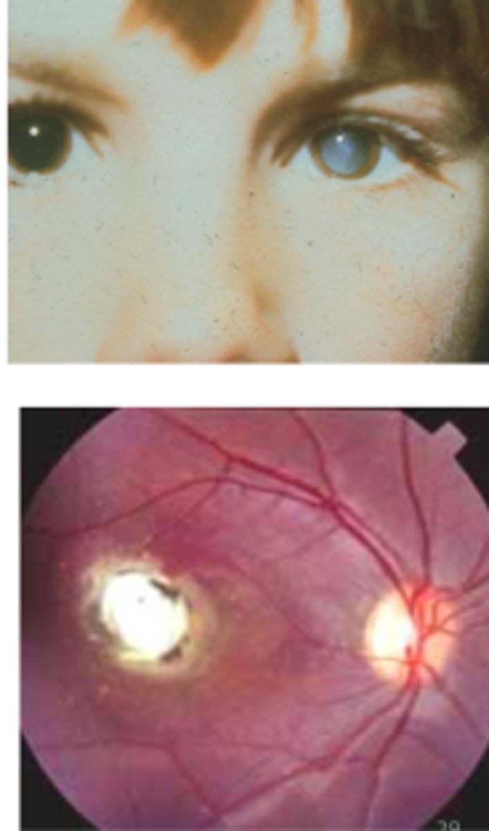 <p>Occurrence of Toxocara larvae in the eye w/inflammatory reaction</p><p>-Occurs in older children (~7.5yrs and more often in males)</p><p>-10,000 cases/yr</p>
