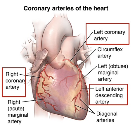 <ul><li><p>reduced blood flow of coronary arteries&nbsp;</p></li><li><p>most common cause is atherosclerosis → build up of fatty plaques in the coronary artery walls</p></li></ul><p></p>