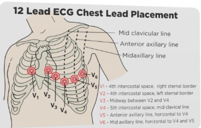 <p>ECG</p><p></p><p>V4 is apex</p>