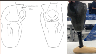 <ul><li><p><span style="color: red;"><strong>Controls <u>Knee extension</u> using the Quadriceps Bar</strong></span></p><ul><li><p>Good<span style="color: red;"> for those that tend to <strong><u>hyperextend</u></strong></span></p></li><li><p>Good for those with short residual limbs</p></li></ul></li></ul><p></p>