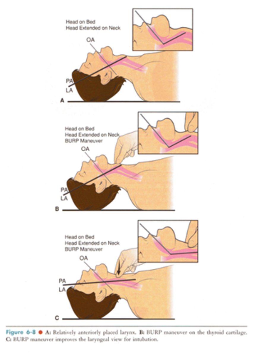 <p>The backward, upward, rightward pressure used during intubation to improve the laryngoscopic view of the glottic opening and vocal cords; also called external laryngeal manipulation</p>