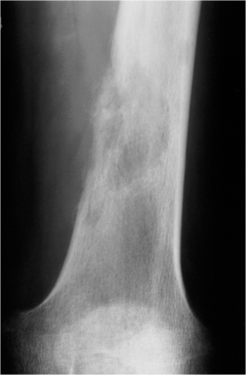 <p>- "Primary Lymphoma"</p><p>- Rare extranodal lymphoma</p><p>- Skeletal involvement in 30% of patients</p><p>- 3-4% of all primary malignant bone tumors</p>