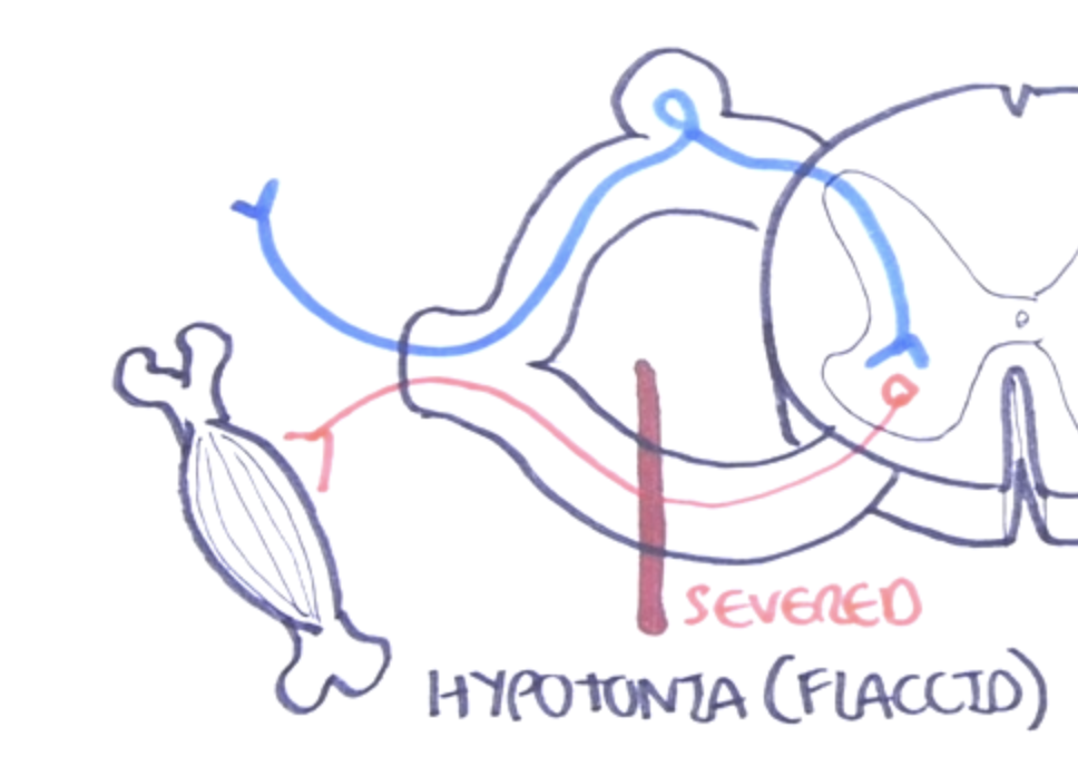 <p>A <strong>severing</strong> of the area <strong>where efferent neurons deliver signals</strong> to the muscle</p>