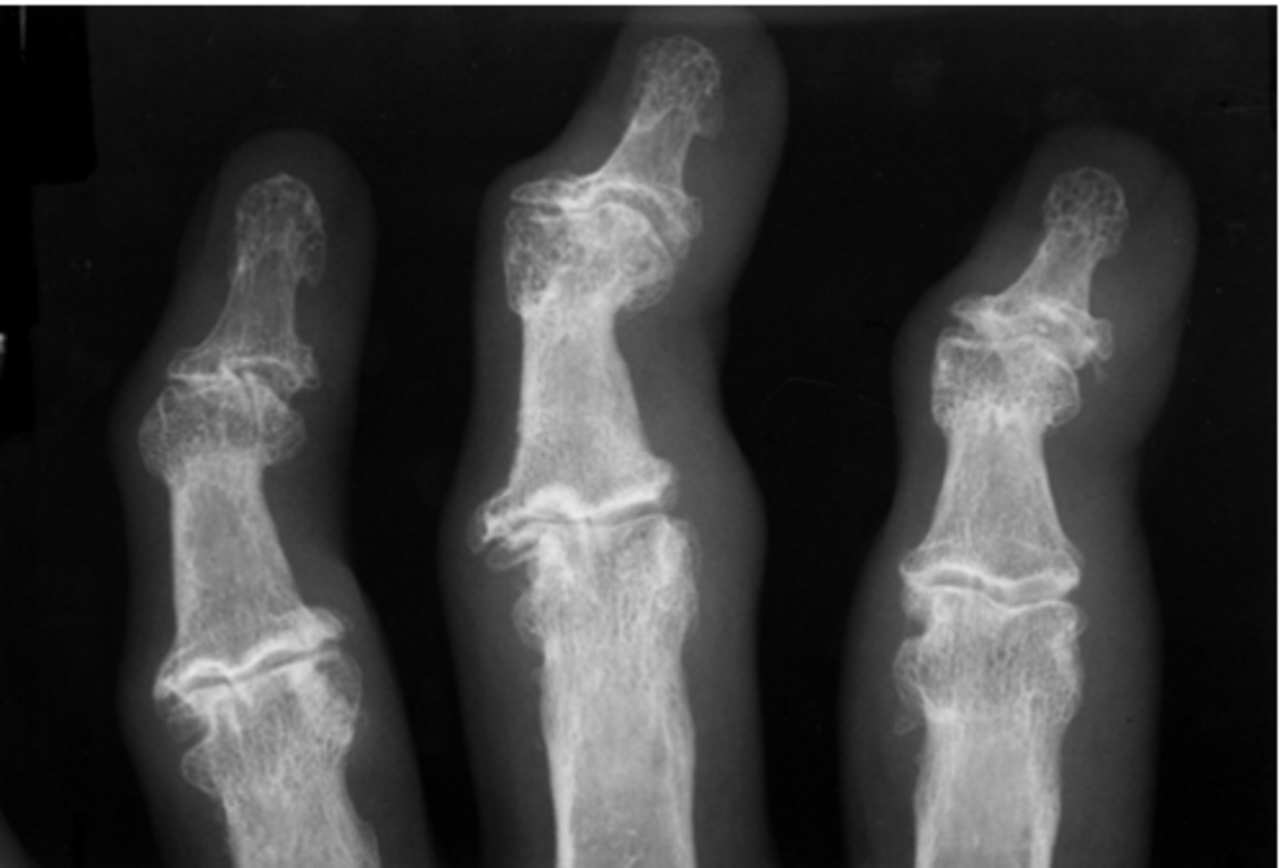 <p>subchondral sclerosis, joint narrowing, osteophytes</p>