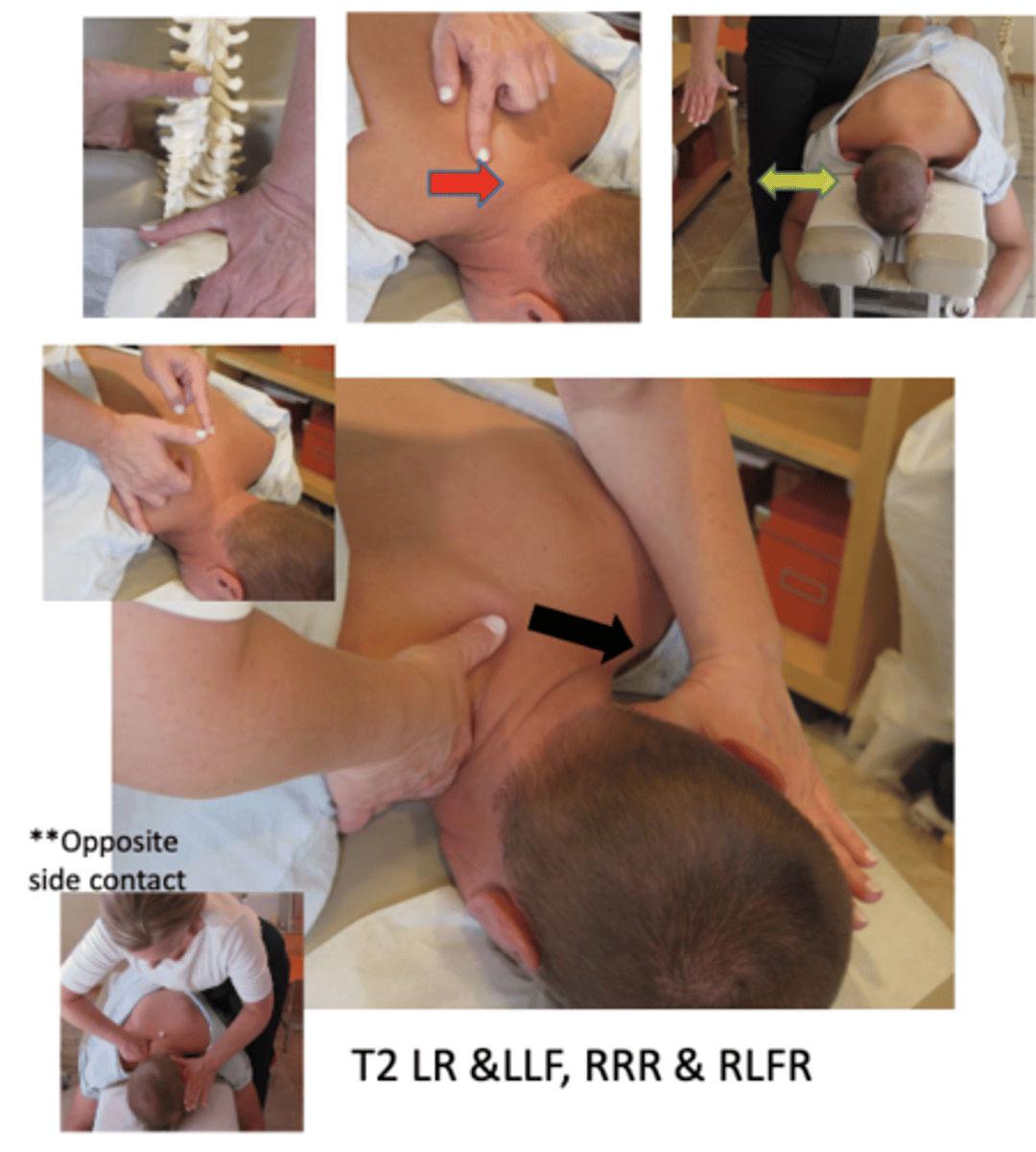 <p>• PP: Prone, headpiece below horizontal to produces light flexion in the thoracocervical spine, permission to open gown/contact, identify segment</p><p>• DP: Standing in low fencer stance on side of contact, facing cephalad, forward leg level at patient's head, body weight centered over midline of the patient</p><p>• CH: Distal palmer surface of cephalad thumb partially abducted and locked, fingers resting on trapezius, contacting lateral surface of spinous process</p><p>• IH: #3 thumb behind the occiput with fingers alongside the face opposite side of contact, inducing slight lateral flexion toward contact with distraction</p><p>• Vector: L-M, slight P-A</p><p>Additional contact - hypothenar OR OPPOSITE SIDEC6-T3</p>