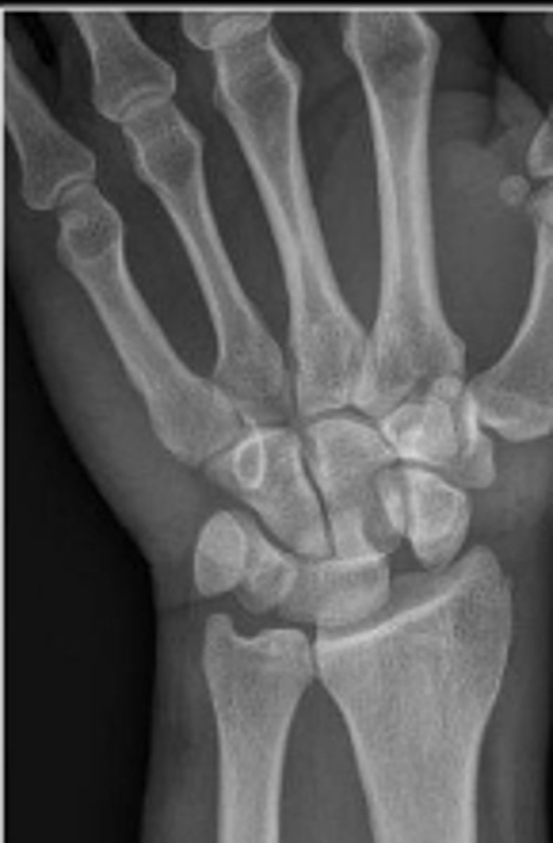 <p>Why are the fingers flexed for the PA wrist?</p>