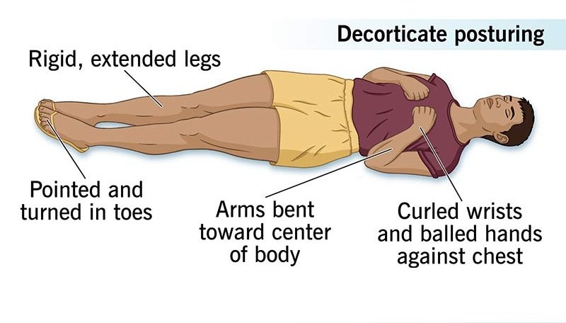 <ul><li><p>Arms <strong>flexed inward</strong> toward the chest, legs extended</p></li><li><p>Indicates <strong>damage to the corticospinal tract</strong> (above the brainstem)</p></li></ul><p></p>