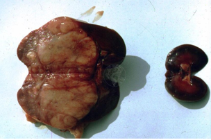 <p>Benign, slow growing</p><p>Not associated with renal dysfunction or failure</p><p>Often incidental finding of ultrasound or PM</p><p>Treatment - monitoring, nephrectomy</p>