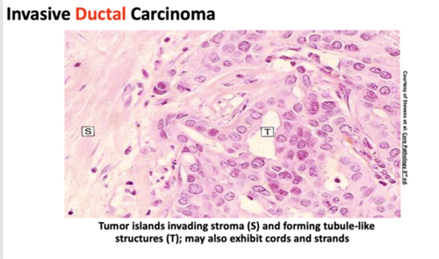 <p>ductal carcinoma</p>