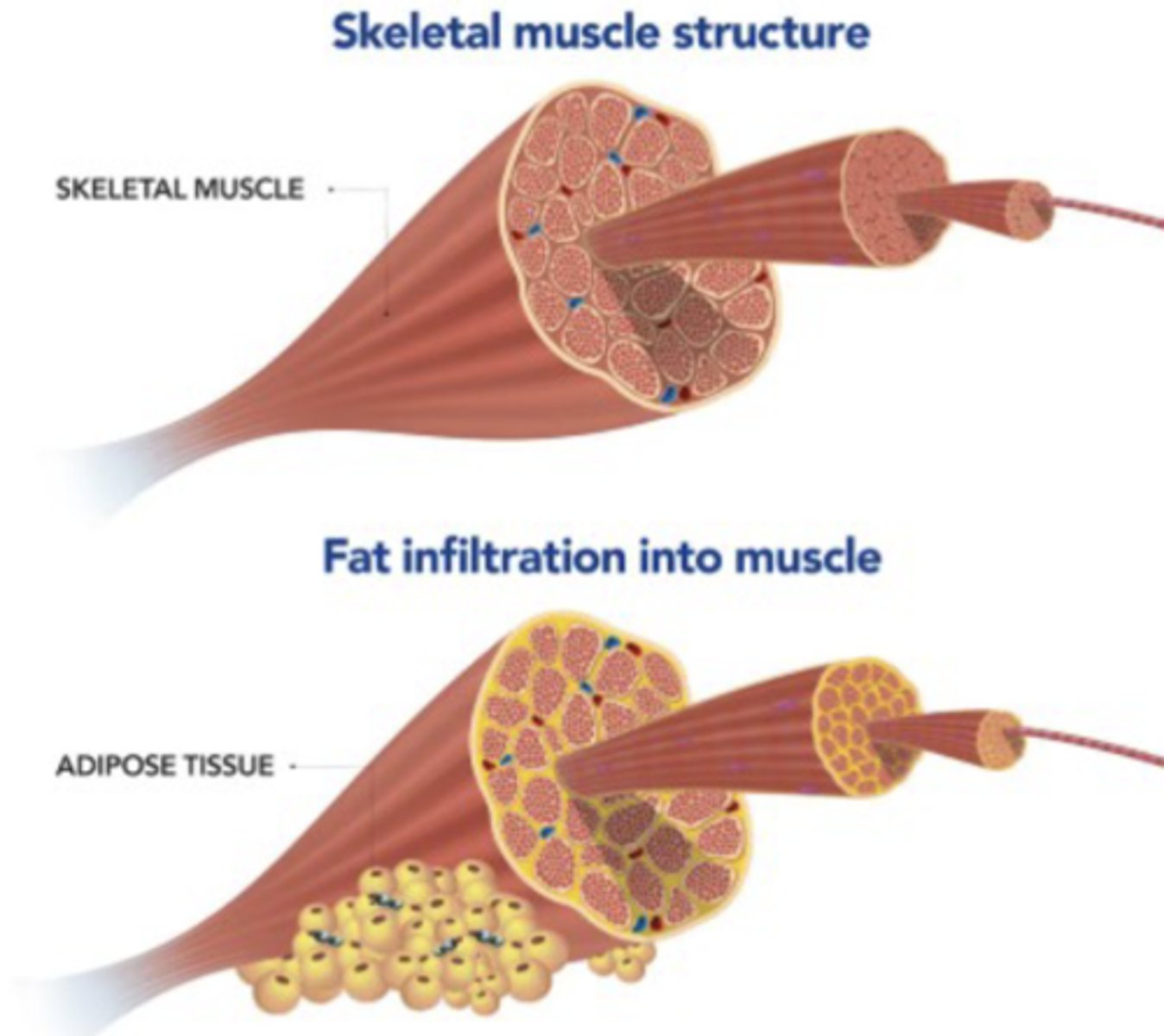 <p>Change in structure/organization of collagen in joint capsules and ligaments after 2 weeks immobilization</p><p>- Due to no stress</p><p>- Rapid degeneration with DENSE fibrofatty conn. tissue</p>