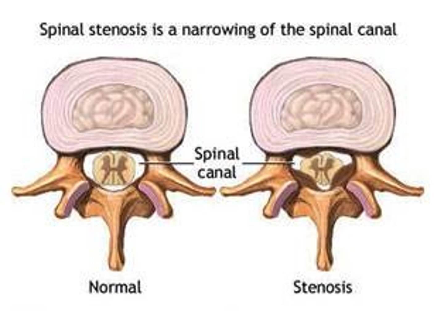 <p>narrowing of the spinal cord (vertebral) canal/foramen</p>