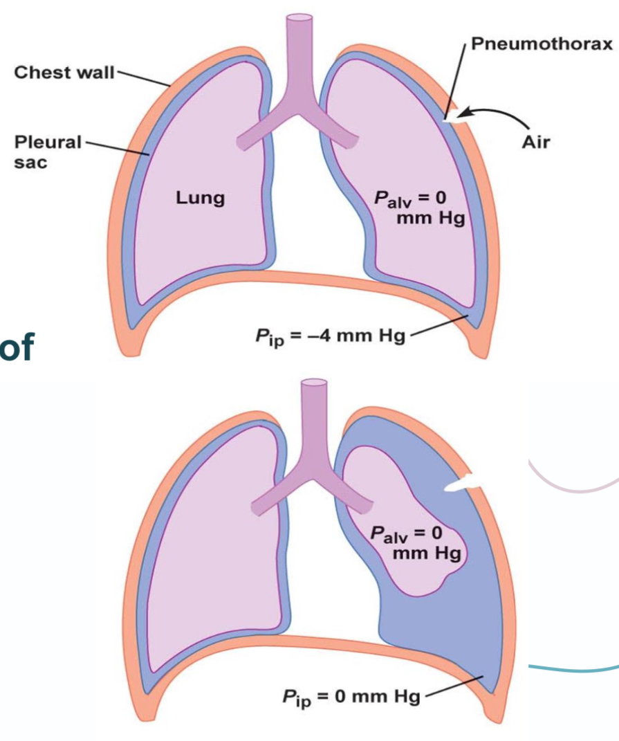 <p>1- loss of trans pulmonary negative pressure</p><p>2- lead to lung collapse </p>