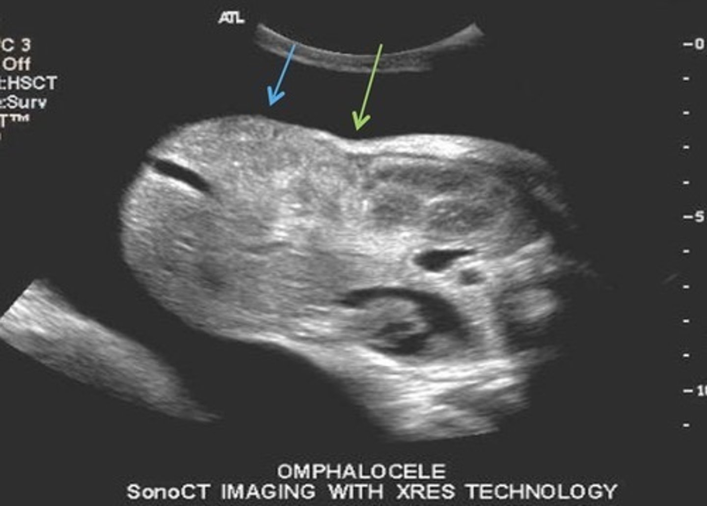 <p>Contains bowel and liver</p><p>20% association with aneuploidy's</p>