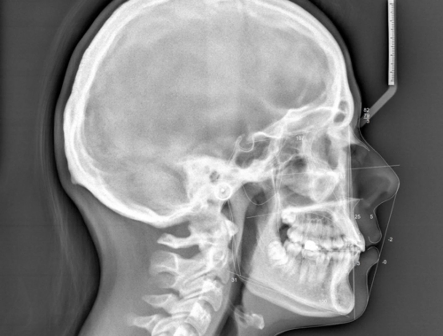 <p>What type of skeletal malocclusion is this patient?</p>
