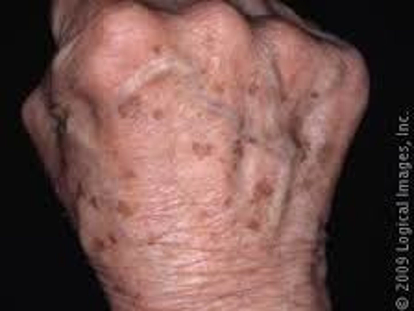 <p>Sun spots, liver spots, age spots </p><p>Smooth, flat, symmetrically pigmented macule or patch found on areas of sun exposure </p><p>Identifies pts who may be high risk for skin cancer </p>