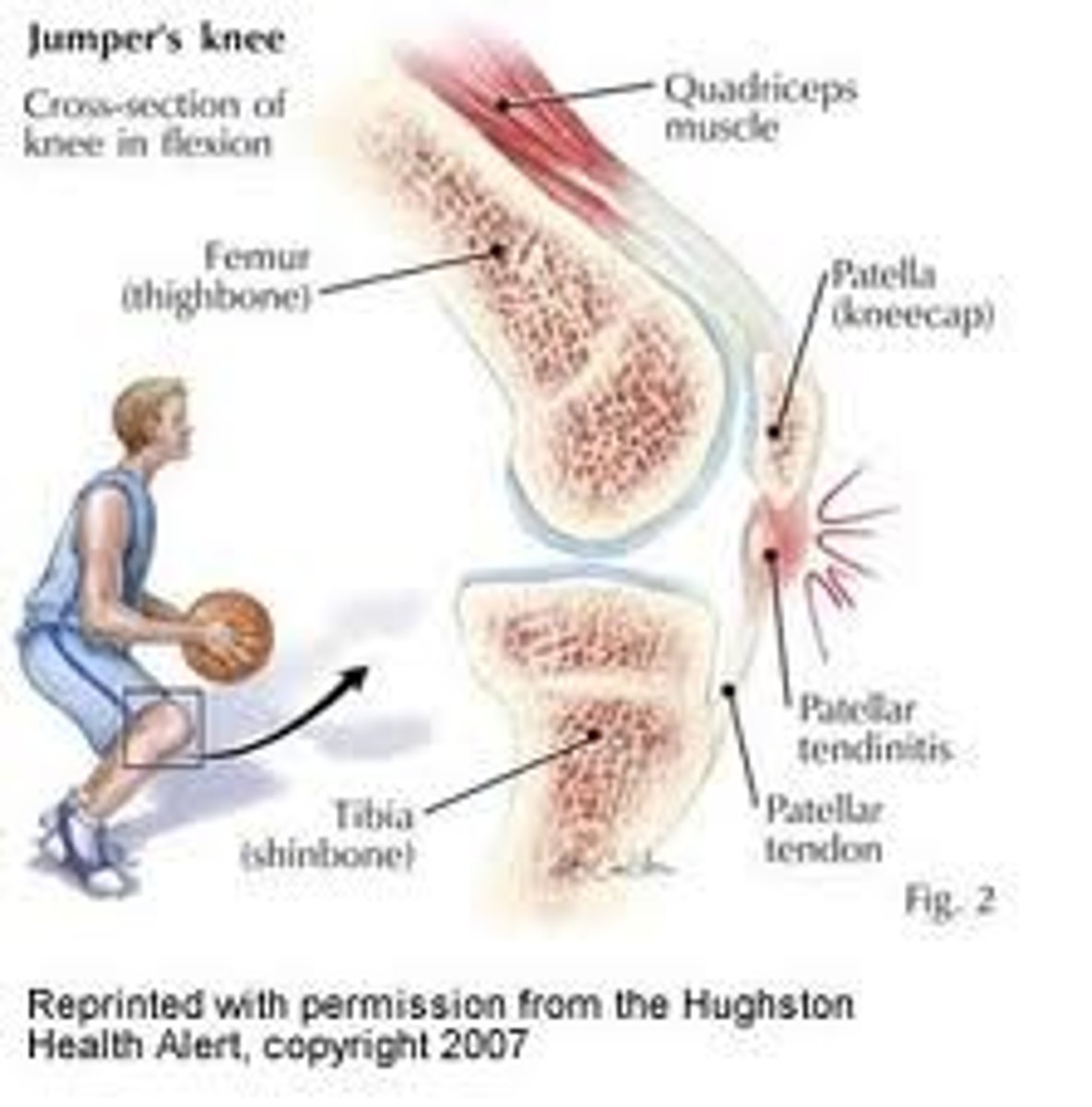 <p>- Age 15-30</p><p>- Inflammation of patellar tendon</p><p>- Onset- gradual</p><p>- MOI- gradual (repeated eccentric overloading during deceleration activities)</p><p>pain increases with squatting and jumping</p><p>end range knee flexion painful</p><p>tender patellar tendon (inferior or superior to patella)</p><p>test: patellar grind test, single leg hip test, high step up test</p>