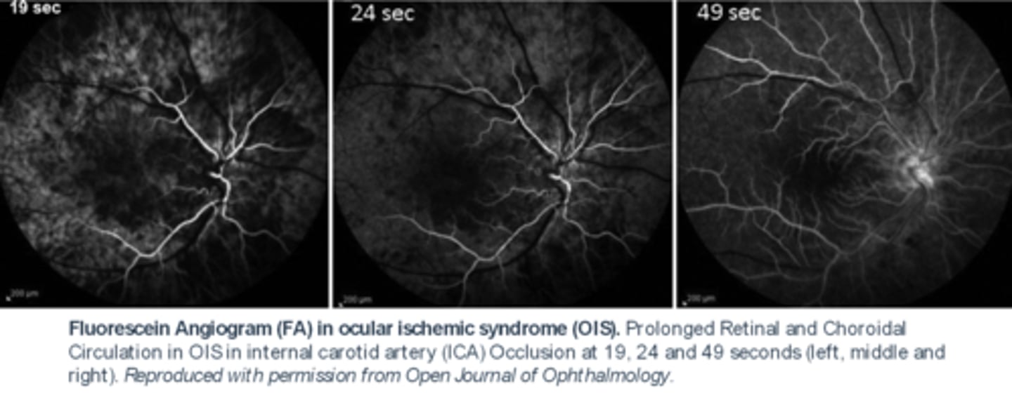 <p>delayed choroidal flush</p><p>AND</p><p>prolonged AV transit time bc veins still not filled at 24 sec here</p>