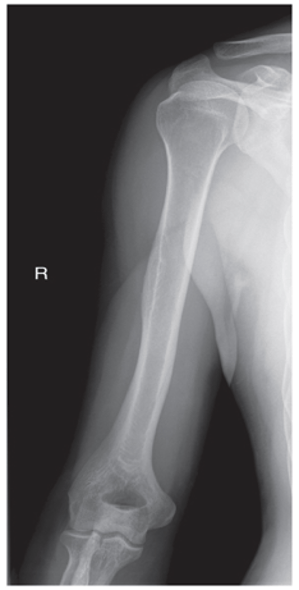 <p>- Include both shoulder and elbow joints</p><p>- CR to midhumerus</p><p>- Entire humerus demonstrated</p><p>- Greater tubercle in profile</p><p>- Medial and lateral epicondyles in profile</p><p>- Exposure factors</p>